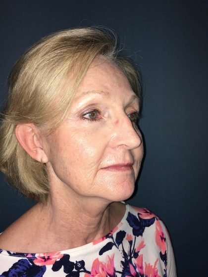 Submentoplasty Before & After Patient #654
