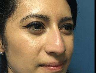 Rhinoplasty Before & After Patient #667