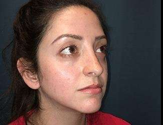 Rhinoplasty Before & After Patient #680