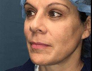 Rhinoplasty Before & After Patient #693