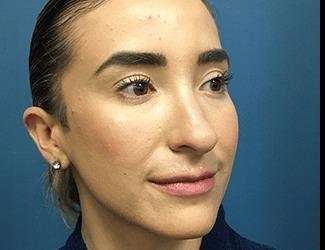Rhinoplasty Before & After Patient #706