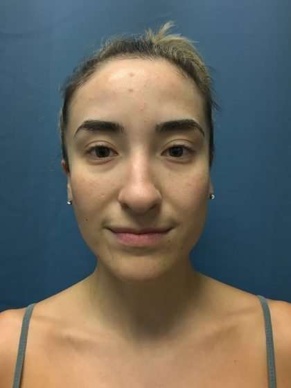 Rhinoplasty Before & After Patient #715