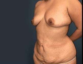 Mommy Makeover Before & After Patient #743