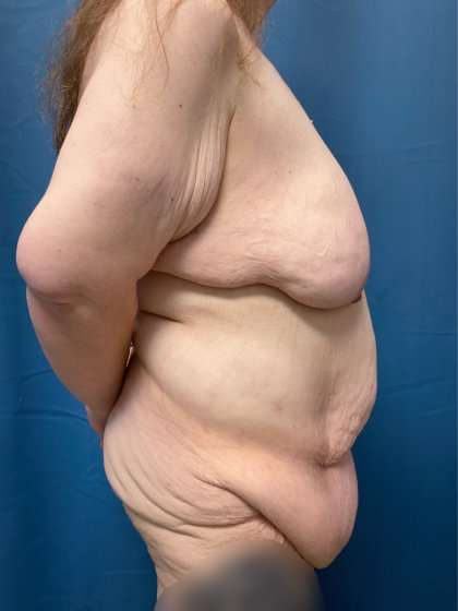 Massive Weight Loss Before & After Patient #986