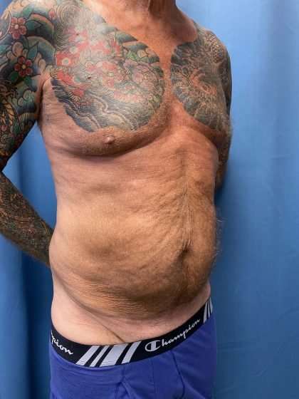 Tummy Tuck Before & After Patient #322