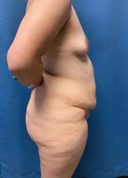 Lower Body Lift Before & After Patient #1008