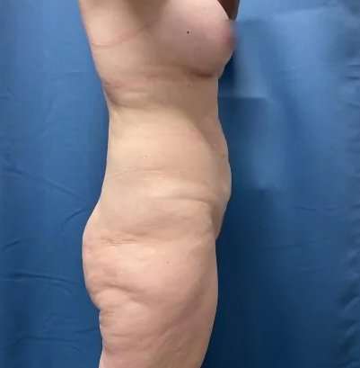 Lower Body Lift Before & After Patient #1034