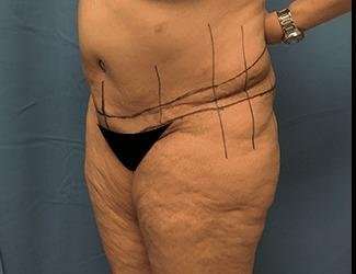 Lower Body Lift Before & After Patient #1047