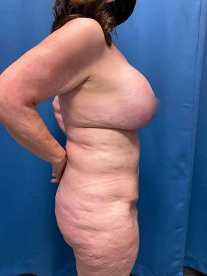 Lower Body Lift Before & After Patient #1063