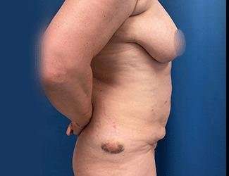 Lower Body Lift Before & After Patient #1094