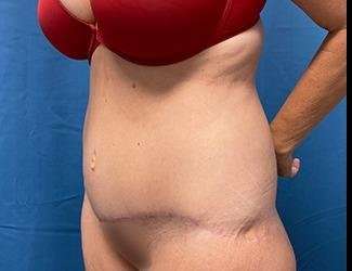 Lower Body Lift Before & After Patient #1127