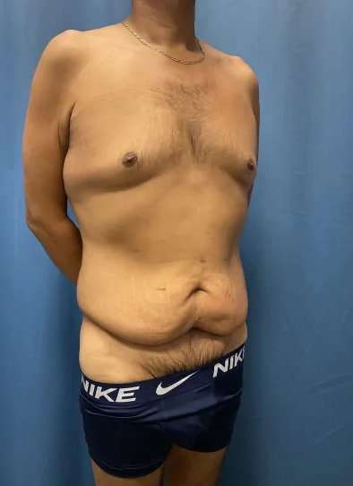 Tummy Tuck Before & After Patient #333