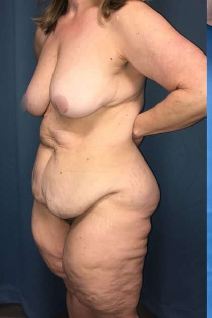 Lower Body Lift Before & After Patient #1174