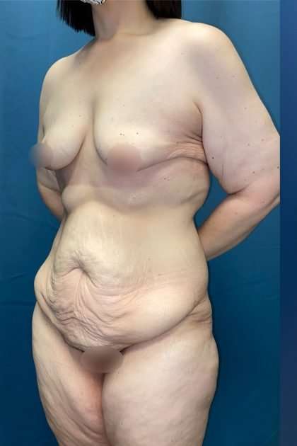 Lower Body Lift Before & After Patient #1187
