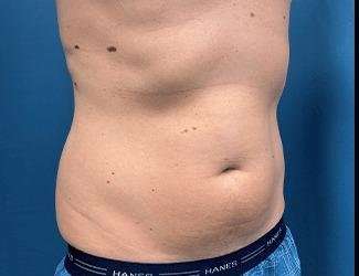 Liposuction Before & After Patient #1257