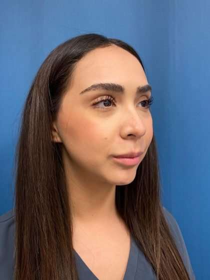 Lip Lift Before & After Patient #1279