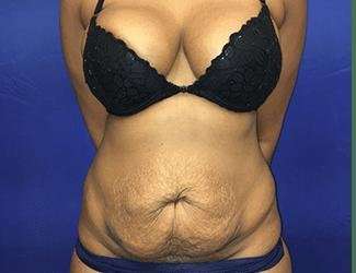 Tummy Tuck Before & After Patient #349