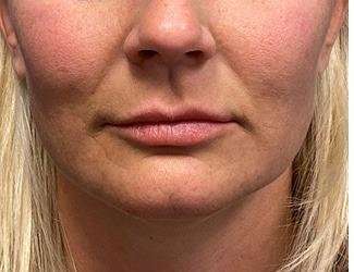 Lip Lift Before & After Patient #1289