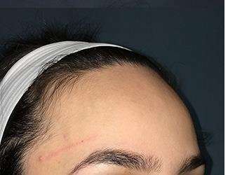 Forehead Reduction Before & After Patient #1364