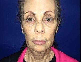 Facial Implants Before & After Patient #1392