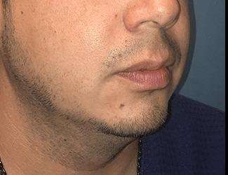 Facial Implants Before & After Patient #1403