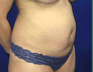 Tummy Tuck Before & After Patient #358