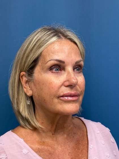 Facelift And Necklift Before & After Patient #1497