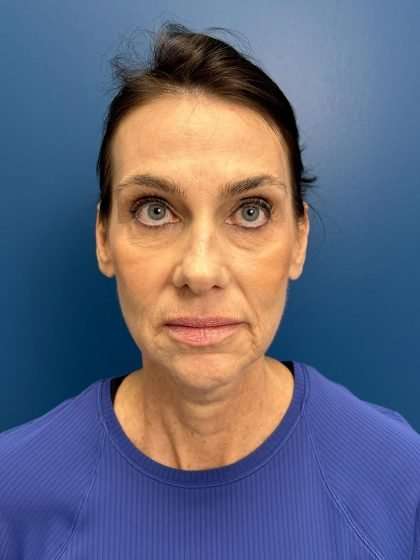 Facelift And Necklift Before & After Patient #1506