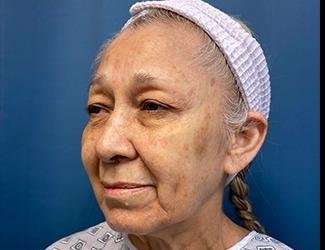 Facelift And Necklift Before & After Patient #1531
