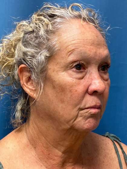 Facelift And Necklift Before & After Patient #1571