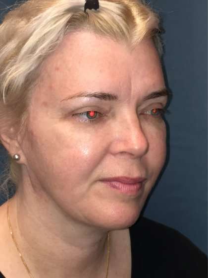 Facelift And Necklift Before & After Patient #1582