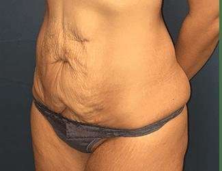Tummy Tuck Before & After Patient #369