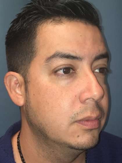 Chin Implant Before & After Patient #1604