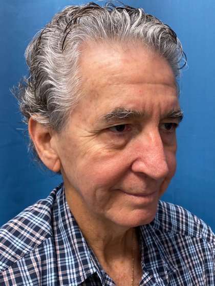 Chin Implant Before & After Patient #1633
