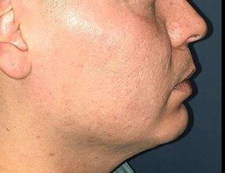 Buccal Fat Removal Before & After Patient #1656
