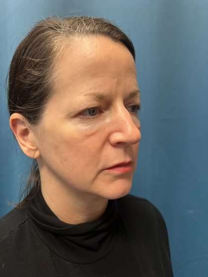 Brow Lift Before & After Patient #1674