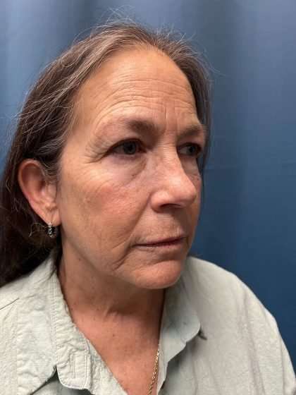 Brow Lift Before & After Patient #1685