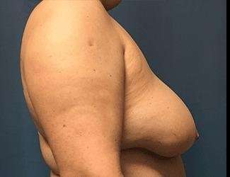 Breast Reduction Before & After Patient #1727