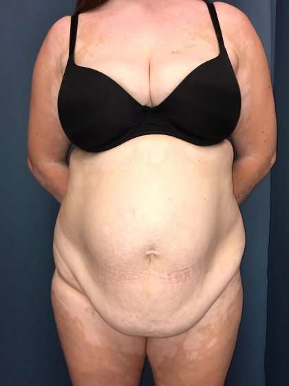 Tummy Tuck Before & After Patient #271