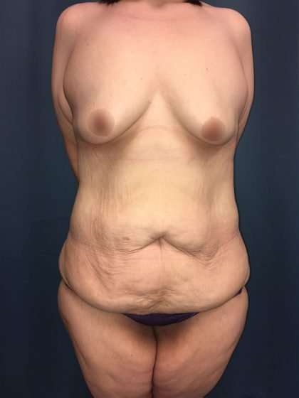 Tummy Tuck Before & After Patient #406