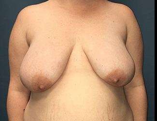 Breast Lift Before & After Patient #1934