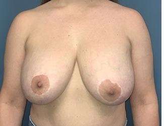 Breast Lift Before & After Patient #1945