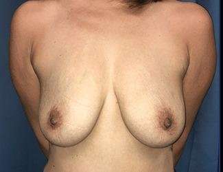 Breast Lift Before & After Patient #1965