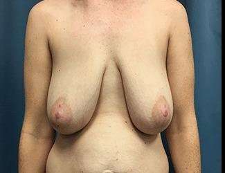Breast Lift Before & After Patient #1978