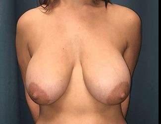 Breast Lift Before & After Patient #1989