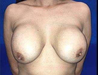 Breast Lift Before & After Patient #2000