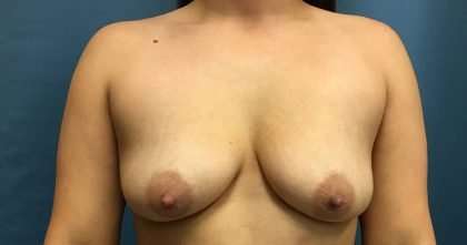 Breast Lift Before & After Patient #2011