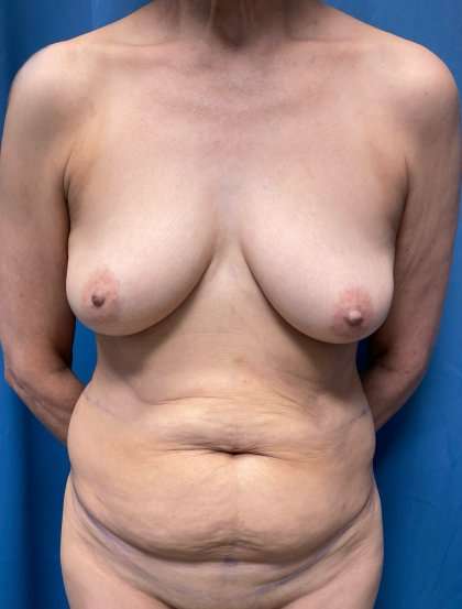 Breast Augmentation Before & After Patient #2027