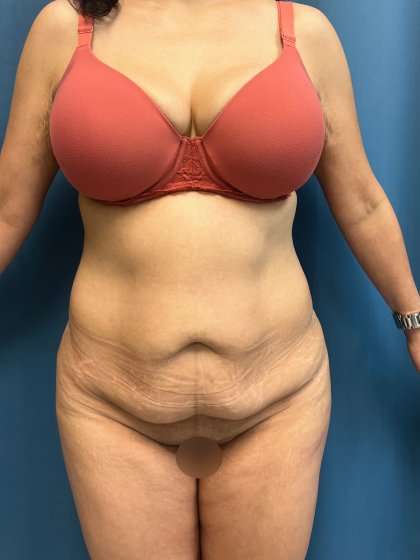 Tummy Tuck Before & After Patient #417