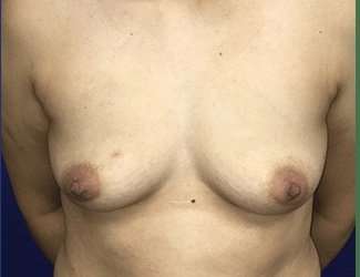 Breast Augmentation Before & After Patient #2069